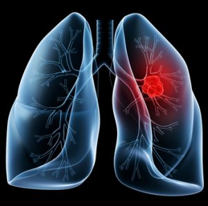 Lung cancer