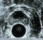 prostate ultrasound