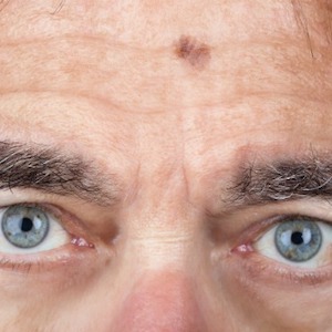melanoma on forehead