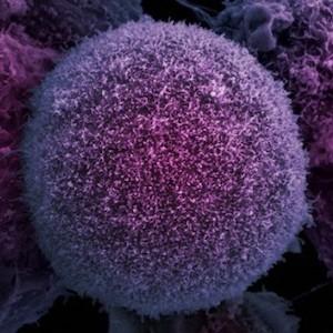 prostate cancer cells